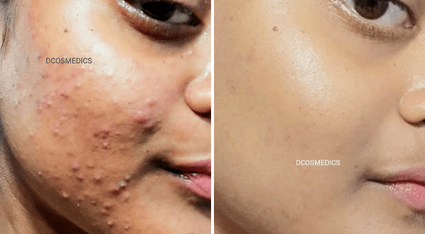 Acne Removal before/after
