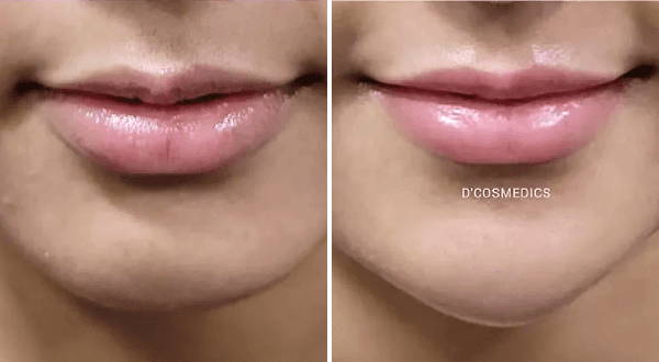 Chin Shaping before/after