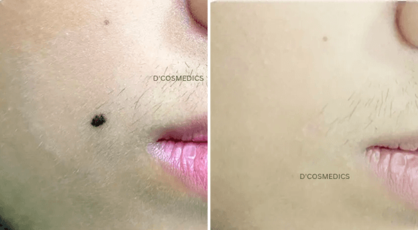 Mole Removal before/after