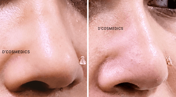 Nose Reshaping before/after