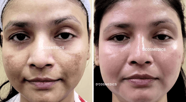 Pigmentation before/after