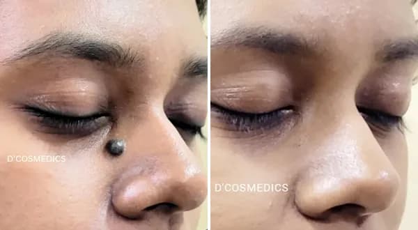 Mole Removal